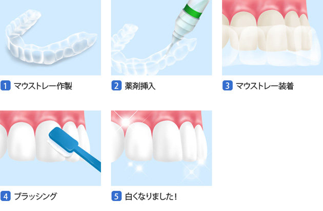 ホームホワイトニング