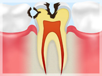 C2：エナメル質の内部の象牙質まで冒された段階です