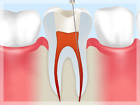 根管治療