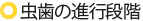 虫歯の進行段階