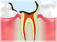 C4：歯の根っこにまで感染が及んだ段階です